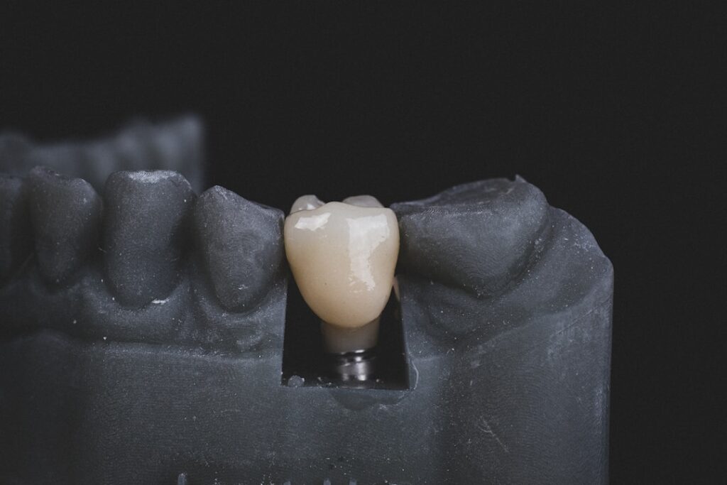 The Dental Implant Procedure: A Step-by-Step Breakdown