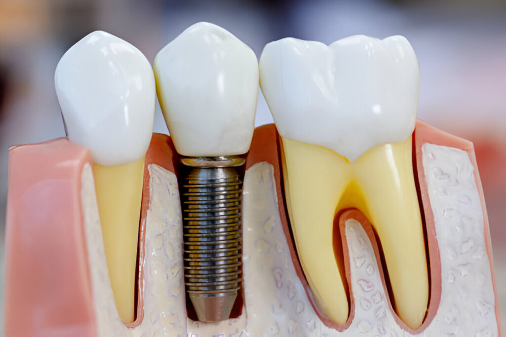 Dental Implants